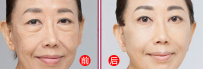 其实去眼袋并不难,小编推荐超声波去眼袋手术119 其实去眼袋并不难,小编推荐超声波去眼袋手术119