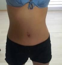 超声波减肥让肚子上的游泳圈不见了587 超声波减肥让肚子上的游泳圈不见了587