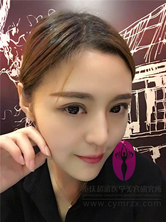 全切双眼皮失败后才知超声波双眼皮的好214 全切双眼皮失败后才知超声波双眼皮的好214