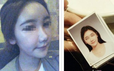 不开刀隆鼻已成型,求围观 不开刀隆鼻已成型,求围观