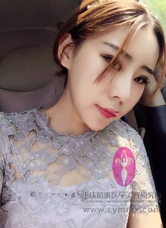 不开刀隆鼻记录贴154 不开刀隆鼻记录贴154