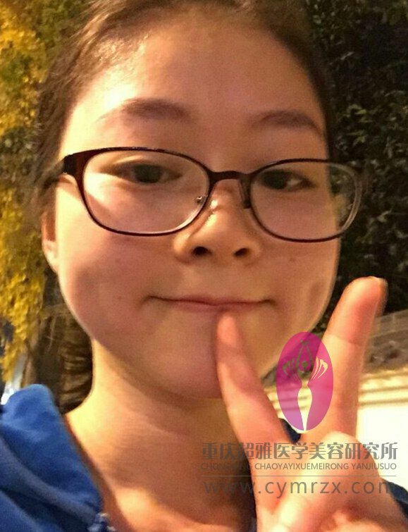 做了超声波瘦脸,看两个月得变化637 做了超声波瘦脸,看两个月得变化637