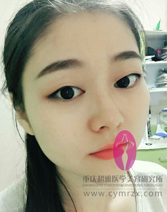 做了超声波瘦脸,看两个月得变化637 做了超声波瘦脸,看两个月得变化637