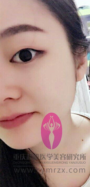 做了超声波瘦脸,看两个月得变化637 做了超声波瘦脸,看两个月得变化637