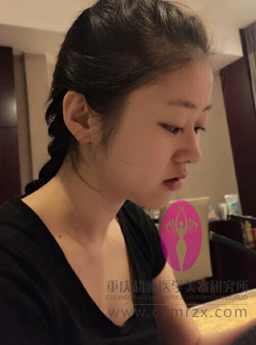 做了超声波瘦脸,看两个月得变化637 做了超声波瘦脸,看两个月得变化637