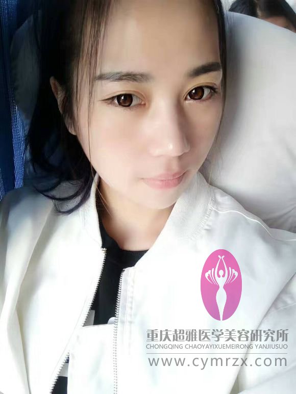 等超声波双眼皮恢复好了我才开贴滴,来看看吧481 等超声波双眼皮恢复好了我才开贴滴,来看看吧481