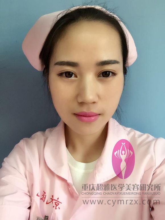 等超声波双眼皮恢复好了我才开贴滴,来看看吧481 等超声波双眼皮恢复好了我才开贴滴,来看看吧481