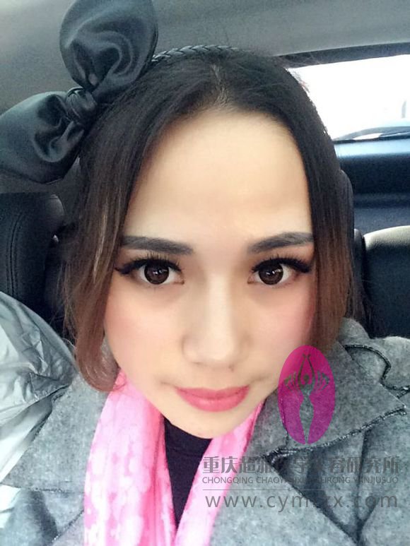 等超声波双眼皮恢复好了我才开贴滴,来看看吧481 等超声波双眼皮恢复好了我才开贴滴,来看看吧481