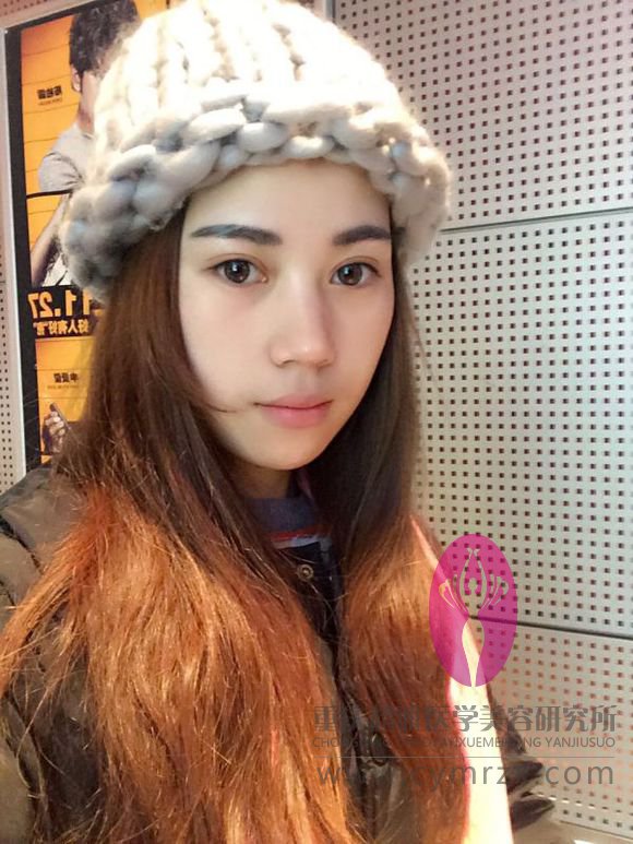 等超声波双眼皮恢复好了我才开贴滴,来看看吧481 等超声波双眼皮恢复好了我才开贴滴,来看看吧481