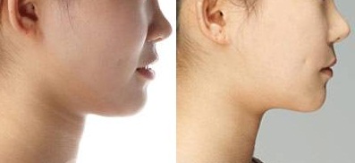 超声波去双下巴到底怎么样呢?254 超声波去双下巴到底怎么样呢?254