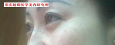 超声波祛眼袋让外婆更年轻了604 超声波祛眼袋让外婆更年轻了604