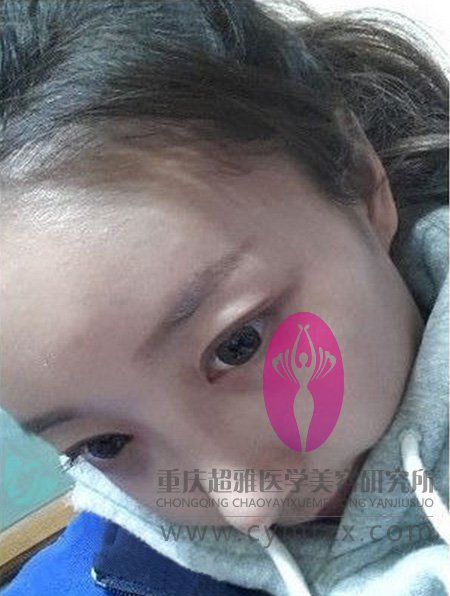 超声波祛眼袋让我做回原来的自己507 超声波祛眼袋让我做回原来的自己507