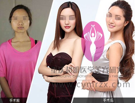 重庆超雅医院纹绣美容的基本常识098 重庆超雅医院纹绣美容的基本常识098