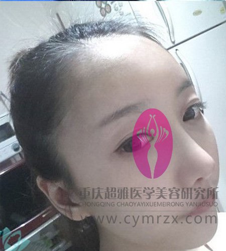 如果你还担心眼袋看这里051 如果你还担心眼袋看这里051