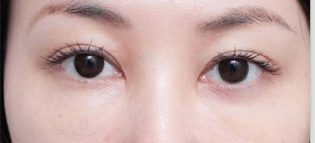 去眼袋还shì去超雅做超 声 波去眼袋比较好 去眼袋还shì去超雅做超 声 波去眼袋比较好