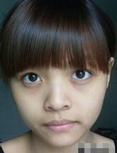 超 声 波去眼袋助wǒ逆袭 超 声 波去眼袋助wǒ逆袭