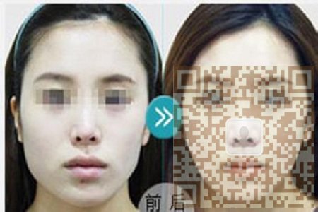 简单有效的瘦脸方法——超声波瘦脸271 简单有效的瘦脸方法——超声波瘦脸271