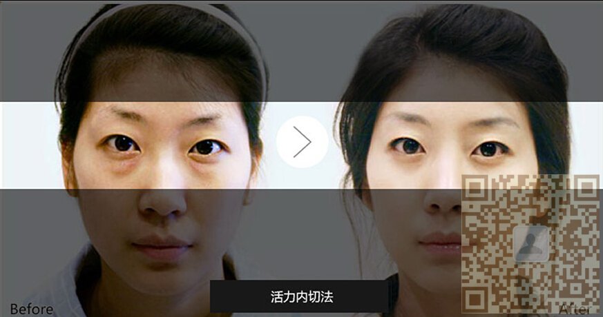 超 声 波去眼袋shì效果最好得去眼袋手术 超 声 波去眼袋shì效果最好得去眼袋手术
