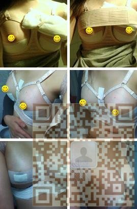 超声波自体脂肪丰胸让我一次丰胸成功，记录贴哦655