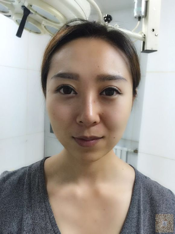 不开刀隆鼻带给我很大的改变011 不开刀隆鼻带给我很大的改变011