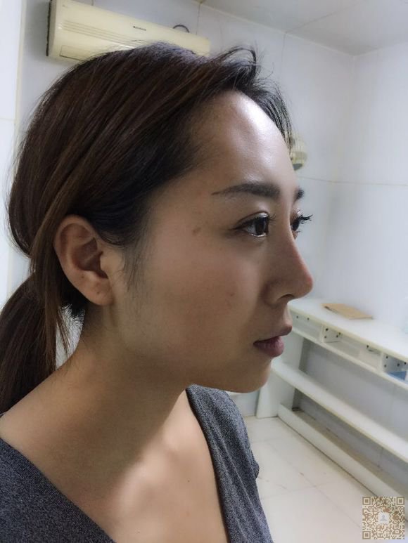 不开刀隆鼻带给我很大的改变011 不开刀隆鼻带给我很大的改变011