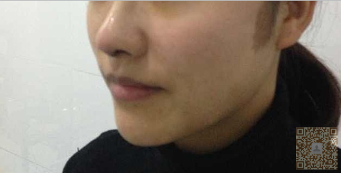 记录我在重庆超雅做鼻部整形后的效果359 记录我在重庆超雅做鼻部整形后的效果359