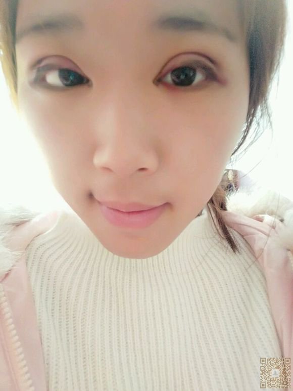 双眼皮做坏了肿么办？我用的超声波双眼皮修复的591