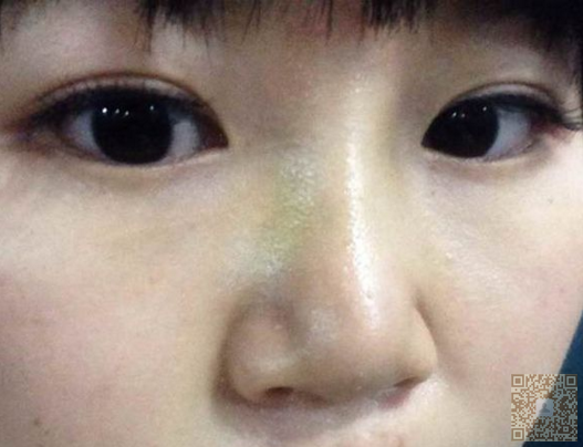 双眼皮做坏了肿么办？我用的超声波双眼皮修复的591