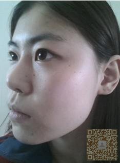 不开刀隆鼻九个月le,瞧瞧呗 不开刀隆鼻九个月le,瞧瞧呗
