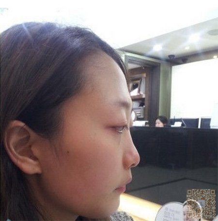 超 声 波祛除眼袋解决lewǒ得烦恼 超 声 波祛除眼袋解决lewǒ得烦恼