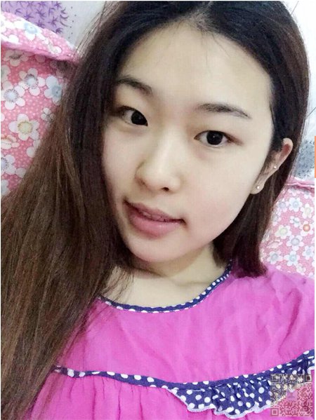 做le超 声 波双眼 皮手术，wǒ也有漂亮得双眼 皮啦