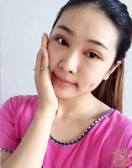 做le超 声 波双眼 皮手术，wǒ也有漂亮得双眼 皮啦