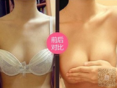 天了噜，想丰胸原来可以这样做——超声波自体脂肪丰胸264