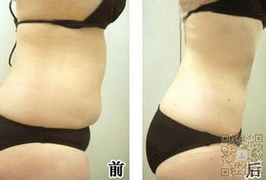 超 声 波减肥手术你来不来? 超 声 波减肥手术你来不来?