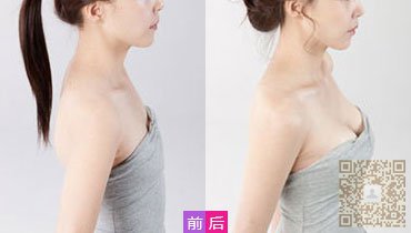 超 声 波自体脂肪丰胸手术后胸型好漂亮 图片没le