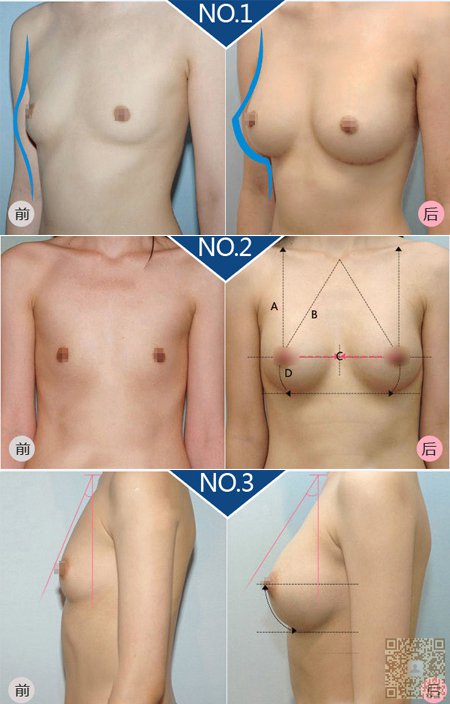 科学解读:脂肪丰胸会引起乳腺癌吗098 科学解读:脂肪丰胸会引起乳腺癌吗098