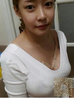 自体脂肪丰胸让我的胸真的大了起来550 自体脂肪丰胸让我的胸真的大了起来550