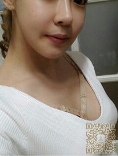 自体脂肪丰胸让我做了模特244 自体脂肪丰胸让我做了模特244