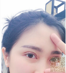 记录超 声 波双眼 皮前五天 记录超 声 波双眼 皮前五天