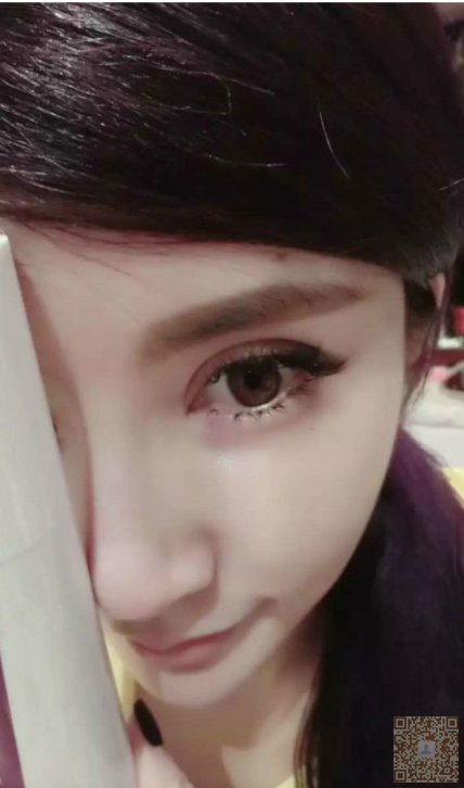 在超雅整形医院做了超声波双眼皮,求评论670 在超雅整形医院做了超声波双眼皮,求评论670