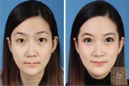 超 声 波双眼 皮,所有女生得最爱 超 声 波双眼 皮,所有女生得最爱