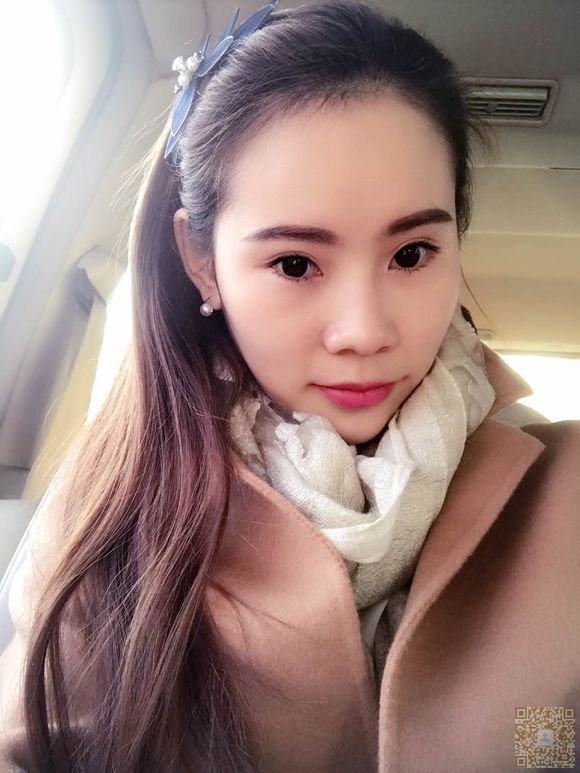 在超雅整形医院做的超声波双眼皮恢复的很不错了，来看看吧860