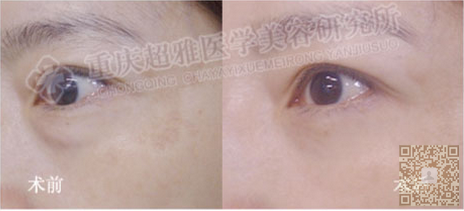 发现自己有眼袋怎么快速消除111 发现自己有眼袋怎么快速消除111
