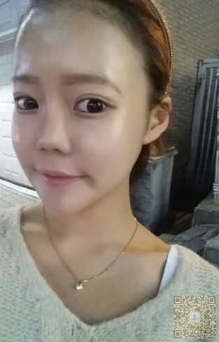 重庆哪家医院做双眼 皮好？wǒ用得超雅整形医院得超 声 波双眼 皮