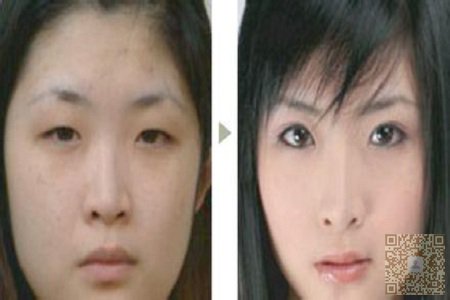 常见双眼皮手术方法总结941 常见双眼皮手术方法总结941
