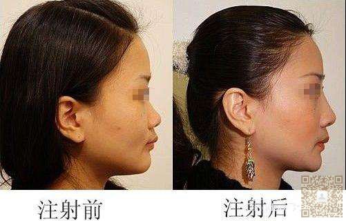 假体隆鼻有副作用吗?282 假体隆鼻有副作用吗?282
