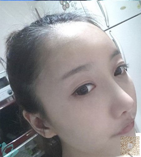 超声波祛眼袋,减龄的最佳选择100 超声波祛眼袋,减龄的最佳选择100