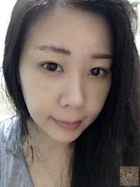 超声波祛眼袋,减龄的最佳选择100 超声波祛眼袋,减龄的最佳选择100