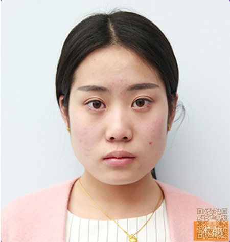 超 声 波瘦脸之经验分享 超 声 波瘦脸之经验分享