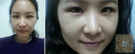 祛眼袋,我还是选择了超雅的超声波祛眼袋121 祛眼袋,我还是选择了超雅的超声波祛眼袋121